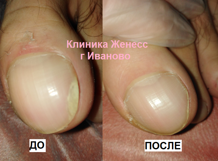 лечение грибка ногтей в Иваново лазером