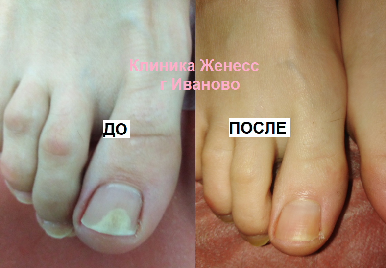 фото до после лазерное лечение грибка ногтей