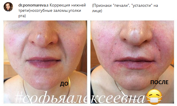филлер до и после, носогубные складки, косметолог Иваново