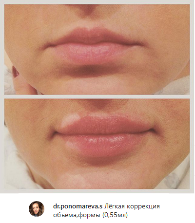 увеличение губ, косметолог Иваново